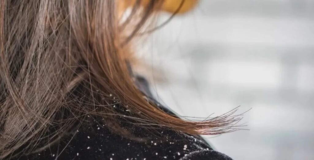 শীতকালে, মাথা থেকে খুশকি ঝরে পড়তে শুরু করে, সমস্যার সমাধানে এই টিপস গুলো জানুন