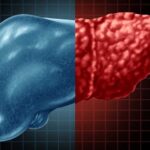 বিশেষজ্ঞদের মতে, ফ্যাটি লিভার পুনরুদ্ধারের জন্য এই সহজ ঘরোয়া প্রতিকারগুলি ব্যবহার করে দেখুন