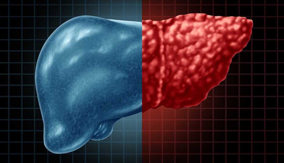 Try these simple home remedies to reverse fatty liver, according to experts