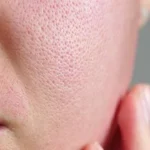 আপনার ত্বকে কি ওপেন পোরসের(ত্বকের বড় বা ফোলা লোমকূপ) এর সমস্যা আছে কিনা, এই ঘরোয়া প্রতিকার দিয়ে তা দূর করুন।