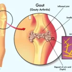 শরীরে ইউরিক অ্যাসিডের মাত্রা বেড়ে গেলে, জয়েন্টগুলোতে তীব্র ব্যথা এবং ফোলাভাব দেখা দেয়, ইউরিক অ্যাসিড নিয়ন্ত্রণের উপায় জানুন