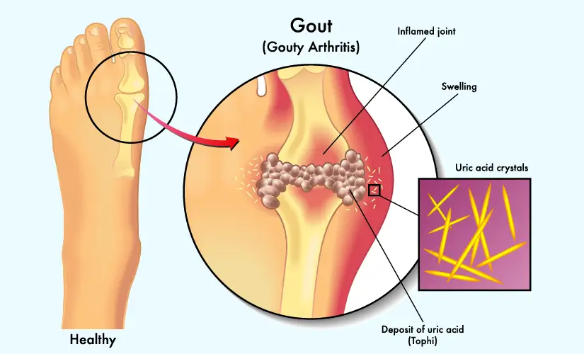 When the level of uric acid in the body increases, know how to control uric acid