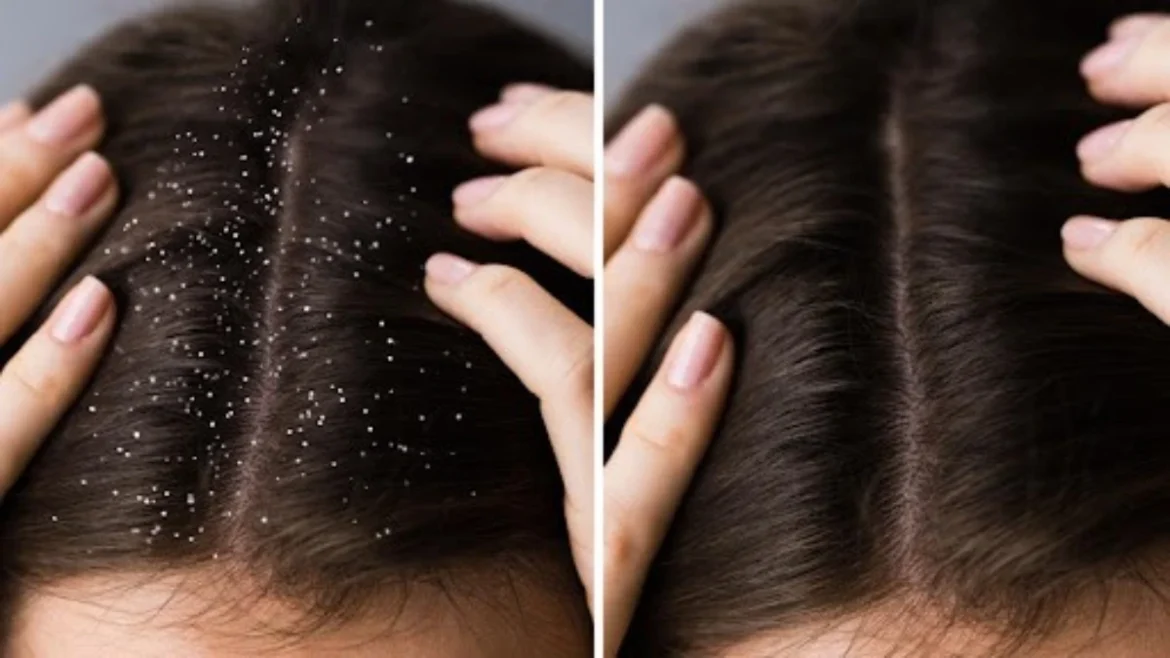 These hair care mistakes can create a layer of dandruff on the scalp, know this