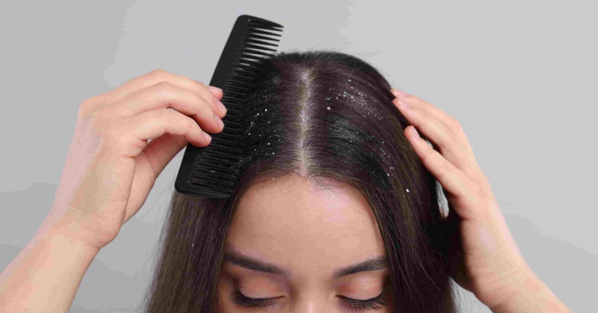 Cold air, low humidity and dry scalp Why is winter hair care more important