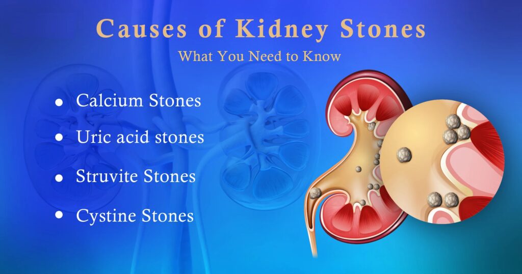 কিডনিতে পাথর গঠনের তিনটি প্রধান কারণ কি? জানুন