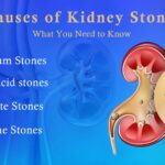 কিডনিতে পাথর গঠনের তিনটি প্রধান কারণ কি? জানুন