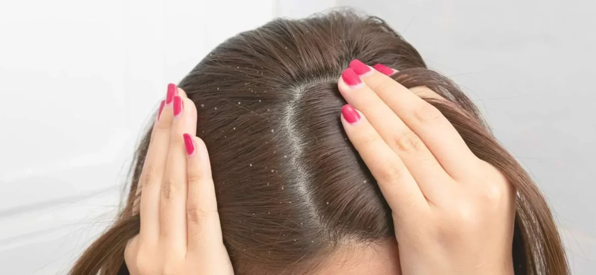 Find out from an expert how to control dandruff naturally in winter.