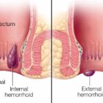 অর্শ থাকলে কি অস্ত্রোপচার করা উচিত? একজন ডাক্তারের কাছ থেকে জেনে নিন কেন অর্শ হয় এবং কীভাবে প্রতিরোধ করা যায়।