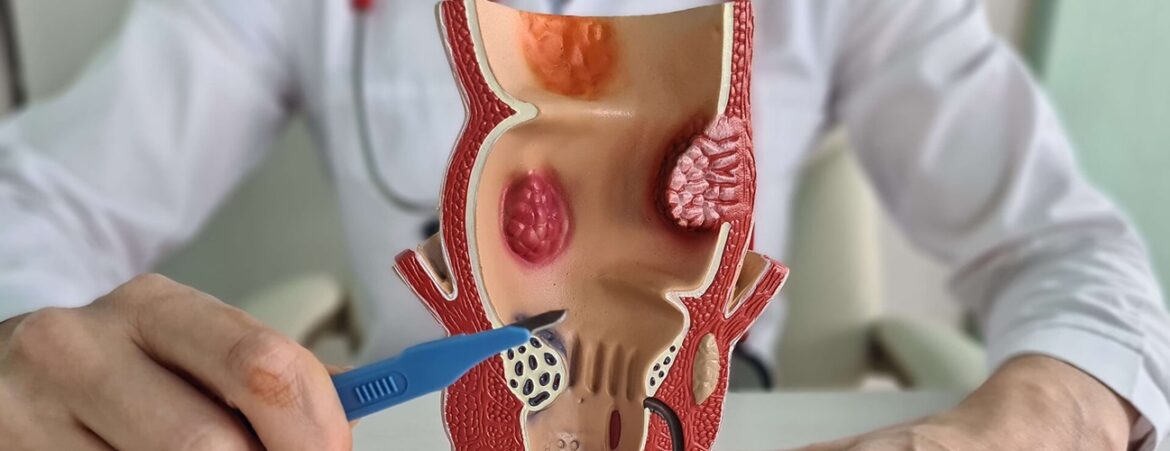 When hemorrhoids turn into ulcers, a doctor explains when medication can provide relief.