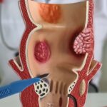 অর্শ কখন আলসারে পরিণত হয়? একজন ডাক্তার ব্যাখ্যা করেছেন কখন ওষুধ উপশম করতে পারে।