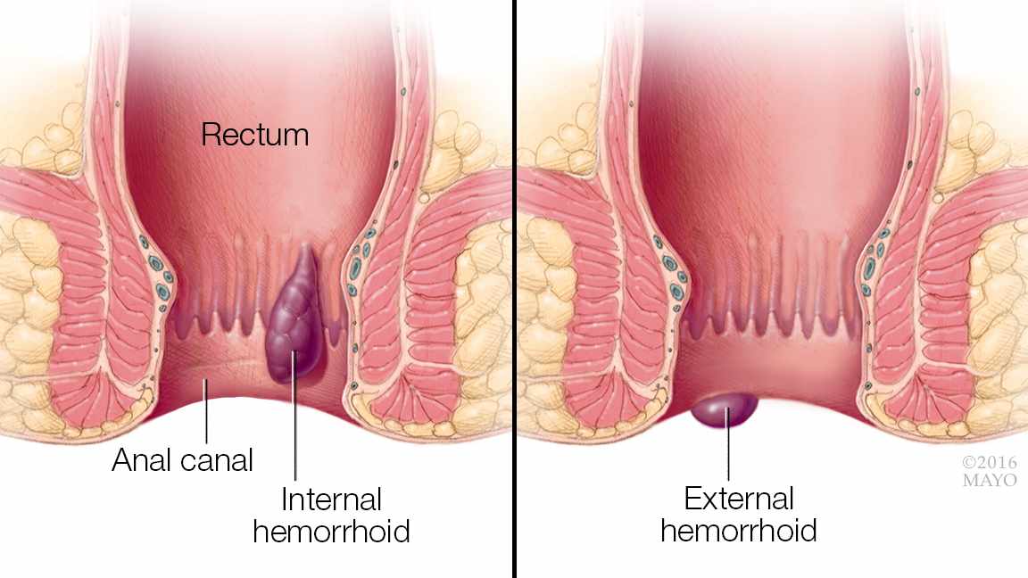Find out from a doctor why hemorrhoids occur and how to prevent them.