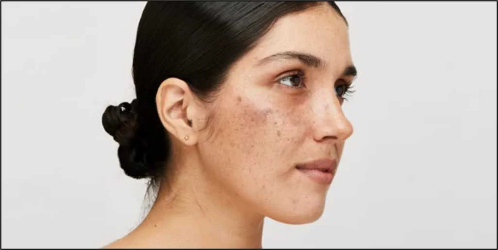 Deficiency of this vitamin can cause spots on the skin, know how to get rid of them here