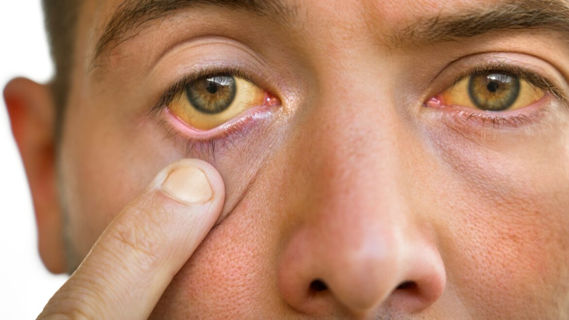These three symptoms that appear in the eyes indicate liver failure; be cautious immediately.
