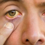 চোখে দেখা দেওয়া এই ৩টি লক্ষণ লিভার ফেইলিওরের ইঙ্গিত দেয়, এখনি সাবধান হন