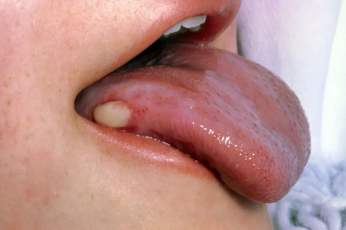 A lump or wart in the mouth is not the only sign of oral cancer; other problems can also indicate risk.