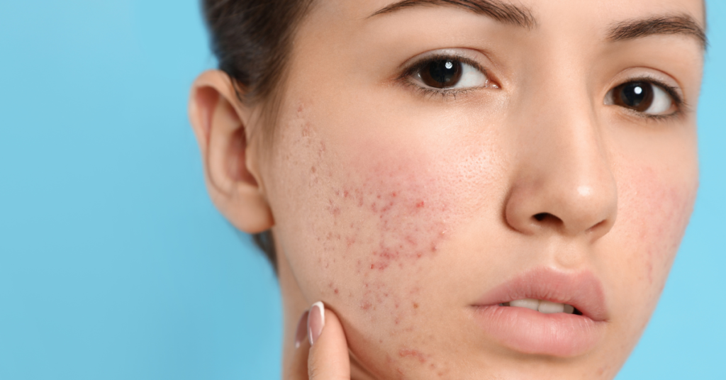 লাল ব্রণের জন্য একটি অলৌকিক প্রতিকার! একজন সেলিব্রিটি পুষ্টিবিদ একটি আয়ুর্বেদিক পেস্টের কথা জানিয়েছেন