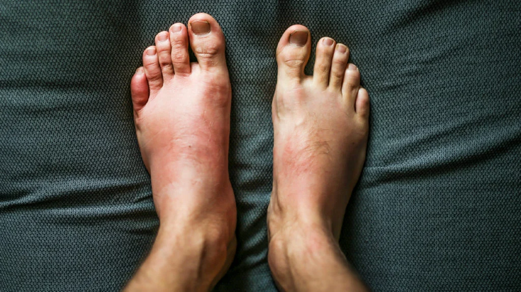 Learn about the possible causes of frequent swelling and severe pain in the body.