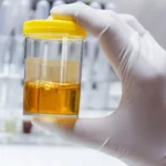 হলুদ প্রস্রাব কি লিভারের ক্ষতির ইঙ্গিত দেয়? একজন aiims ডাক্তারের কাছ থেকে জেনে নিন।