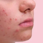 মুখের ব্রণ এবং পেটের মধ্যে কি সম্পর্ক? একজন আয়ুর্বেদ বিশেষজ্ঞের কাছ থেকে জেনে নিন