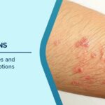 ত্বকের বারবার সংক্রমণ কোন রোগের ইঙ্গিত দেয়? জানুন এর কারণ ও প্রতিকার সম্পর্কে