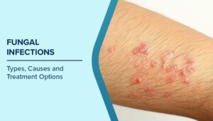 ত্বকের বারবার সংক্রমণ কোন রোগের ইঙ্গিত দেয়? জানুন এর কারণ ও প্রতিকার সম্পর্কে