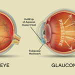 গ্লুকোমার লক্ষণগুলো কি কি? চোখের এই রোগটি কতটা বিপজ্জনক? জানুন