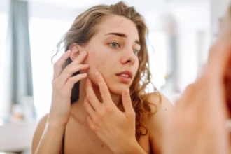 দামি চিকিৎসার ছাড়ুন! ব্ল্যাকহেডস ও হোয়াইটহেডস থেকে মুক্তি পান—শুধু ব্যবহার করুন এই ৩টি উপাদান