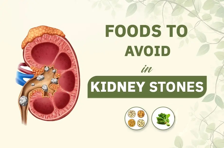 ৫ টি খাবার যা কিডনিতে পাথর হওয়ার ঝুঁকি বাড়ায়, আপনি কি খাচ্ছেন সেগুলো?
