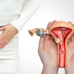 নারীদের মধ্যে pcos-এর প্রধান কারণ কি? এটি কীভাবে বন্ধ্যাত্বের দিকে নিয়ে যায়?