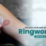 ক্রিম ব্যবহারের পরেও কি দাদ (ringworm) সারছে না? এই ঘরোয়া পেস্টটি মাত্র ৭ দিনেই দেবে স্বস্তি