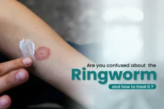 ক্রিম ব্যবহারের পরেও কি দাদ (ringworm) সারছে না? এই ঘরোয়া পেস্টটি মাত্র ৭ দিনেই দেবে স্বস্তি